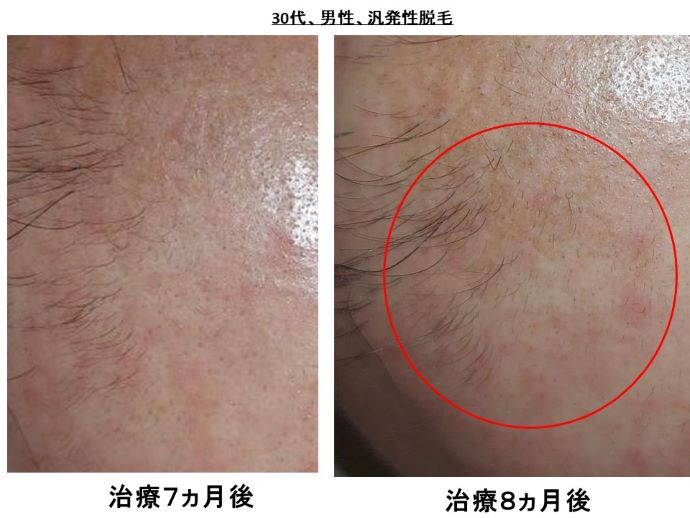 円形脱毛症　病院